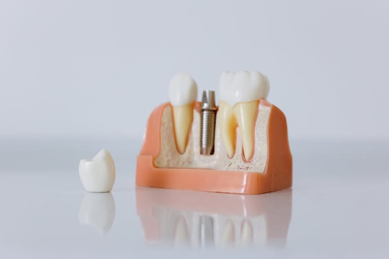 Dental Implants in Vadodara — Ashirvad Dental Clinic
