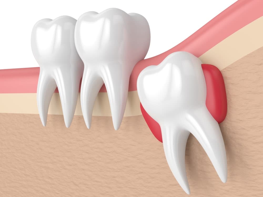 Wisdom Tooth Removal